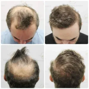 Hair restoration result — Case 01