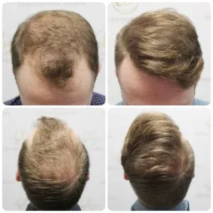 Hair restoration result — Case 02