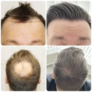 Hair restoration result — Case 03