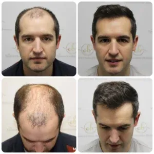 Hair restoration result — Case 04