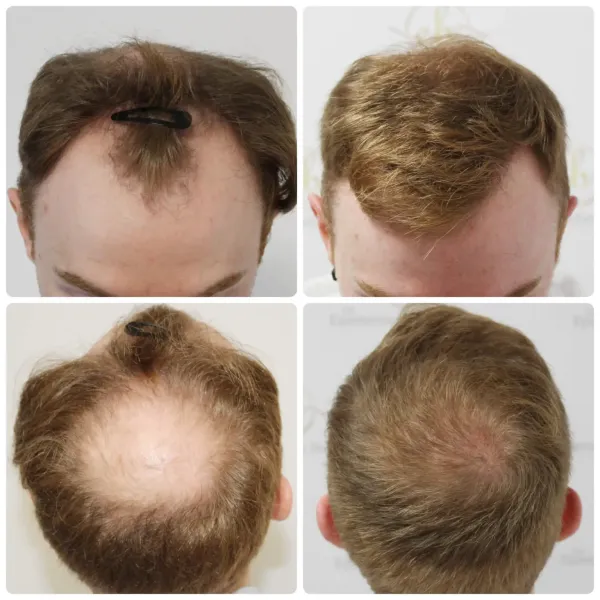 Hair restoration result — Case 05
