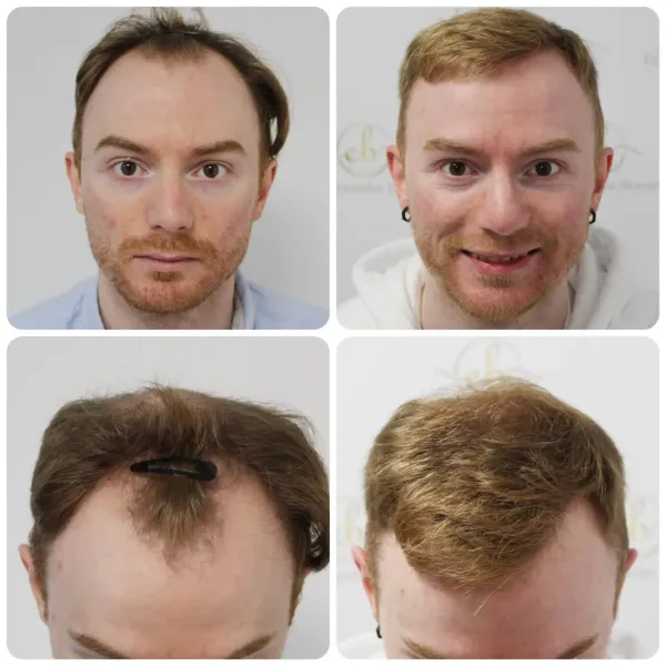Hair restoration result — Case 06